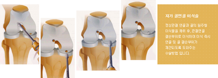 자가 골연골 이식술 :
			정상관련 연골과 골의 원주형 이식물을 재취 후, 관절연골 결손부위로 이식하여 이식 즉시 연골 및 골 결손부위가 재건되도록 도와주는 수술방법입니다.