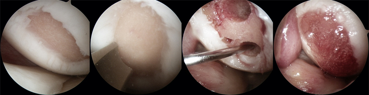 수술과정 : 관절내시경을 이용한 Cartistem 이식과정 사진