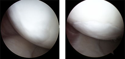 수술 1년 후 연골재생확인 사진