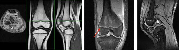 무릎 성장판 MRI